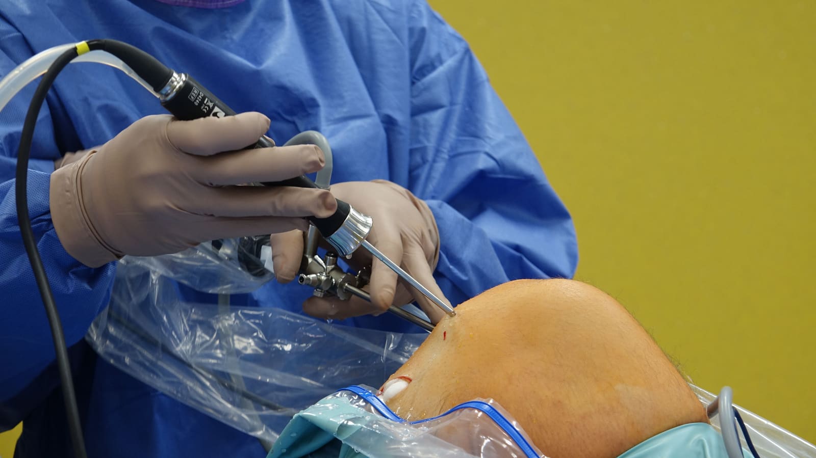 ACL Reconstruction: A Realistic Recovery Timeline